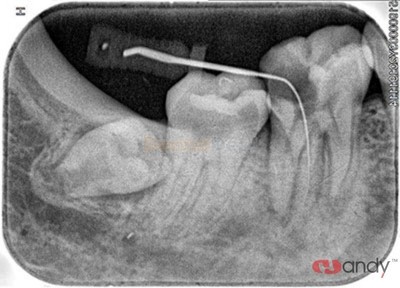 Handy HDS-500 Dental Phosphor Plate Scanner PSP Scanner